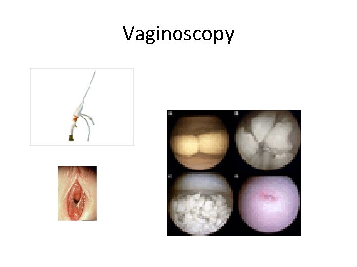 Vaginoscopy 
