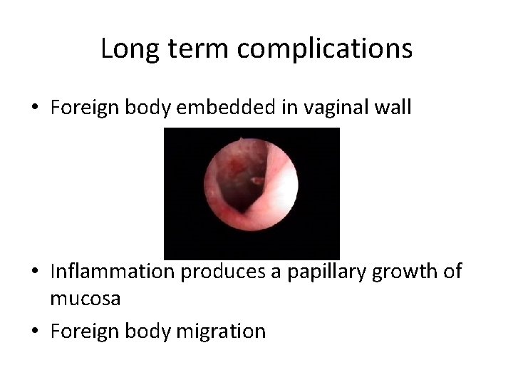 Long term complications • Foreign body embedded in vaginal wall • Inflammation produces a