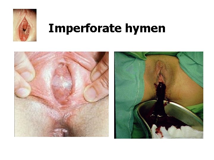 Imperforate hymen 