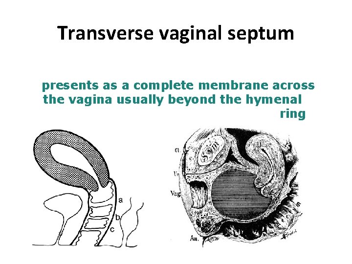 Transverse vaginal septum presents as a complete membrane across the vagina usually beyond the