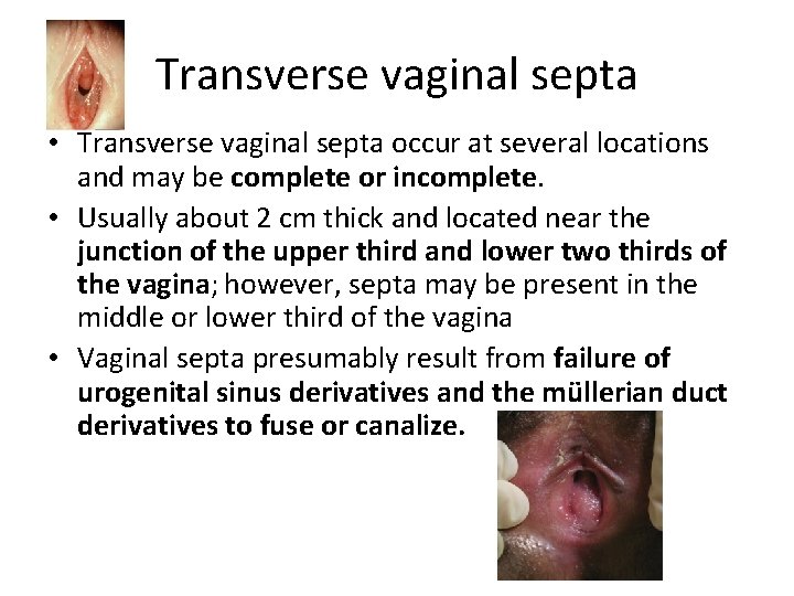 Transverse vaginal septa • Transverse vaginal septa occur at several locations and may be