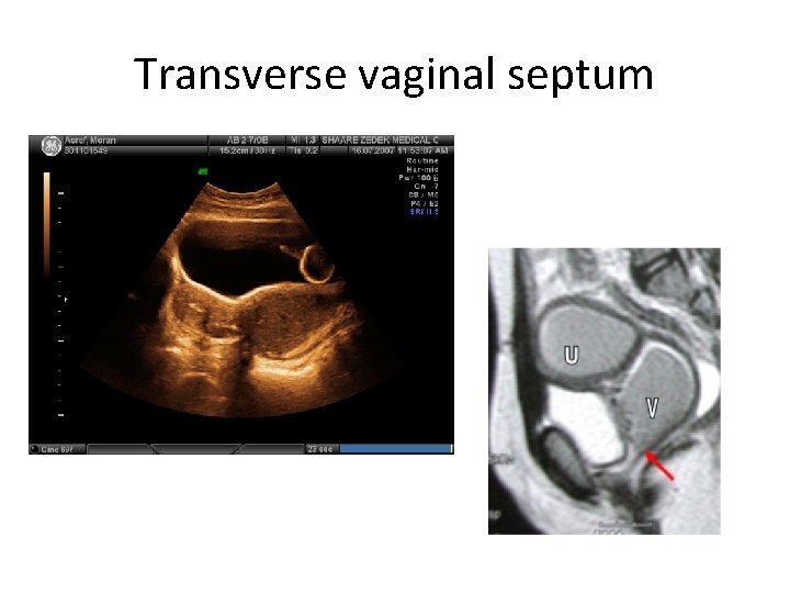 Transverse vaginal septum 