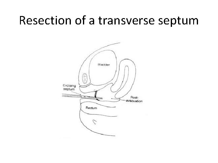 Resection of a transverse septum 
