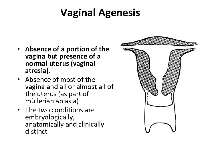 Vaginal Agenesis • Absence of a portion of the vagina but presence of a