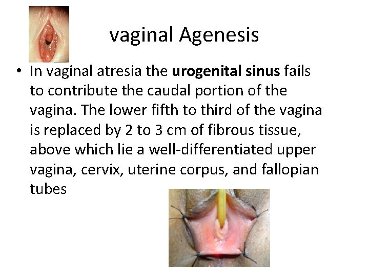 vaginal Agenesis • In vaginal atresia the urogenital sinus fails to contribute the caudal