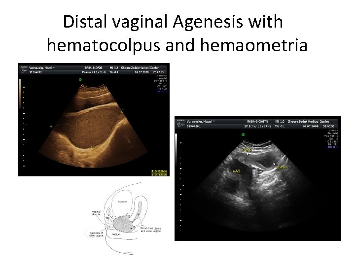 Distal vaginal Agenesis with hematocolpus and hemaometria 