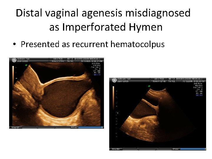 Distal vaginal agenesis misdiagnosed as Imperforated Hymen • Presented as recurrent hematocolpus 