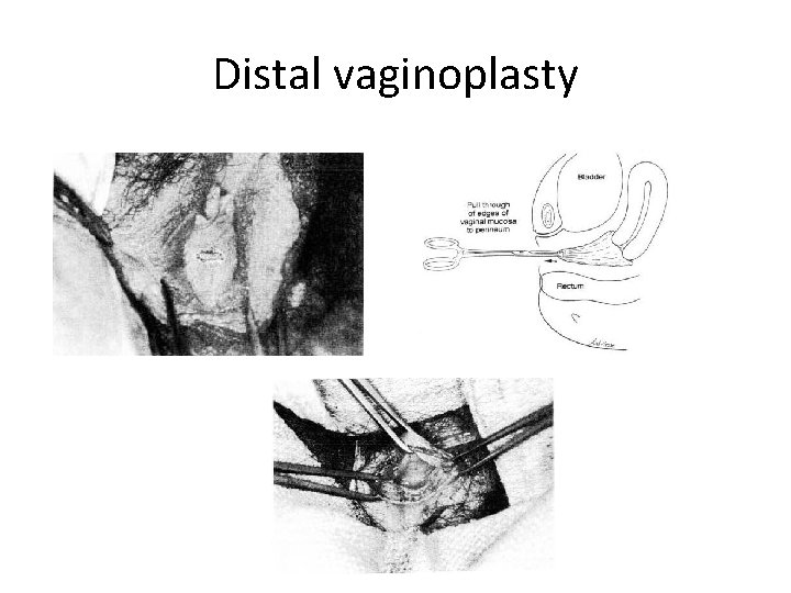 Distal vaginoplasty 