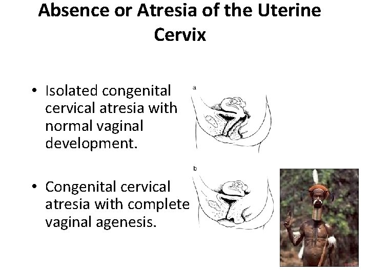 Absence or Atresia of the Uterine Cervix • Isolated congenital cervical atresia with normal