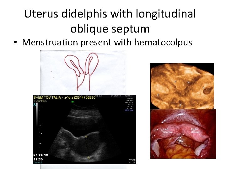 Uterus didelphis with longitudinal oblique septum • Menstruation present with hematocolpus 