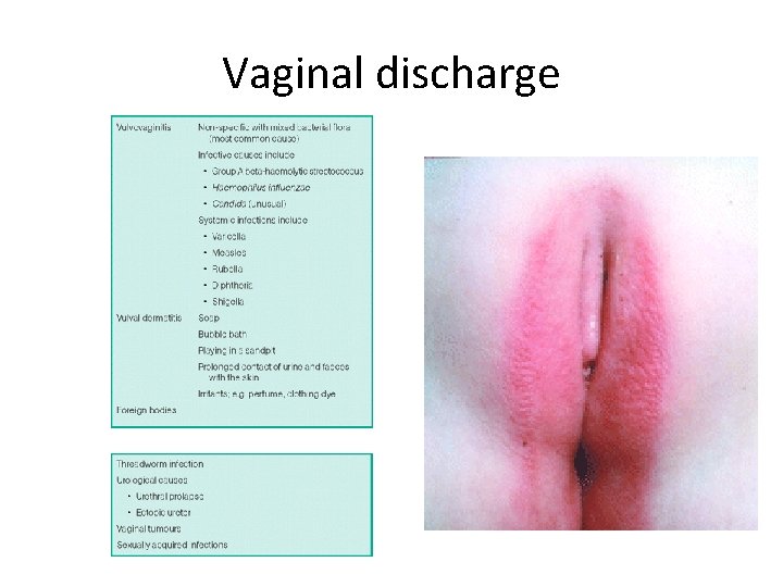 Vaginal discharge 