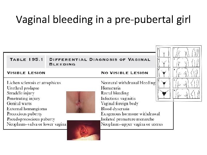 Vaginal bleeding in a pre-pubertal girl 