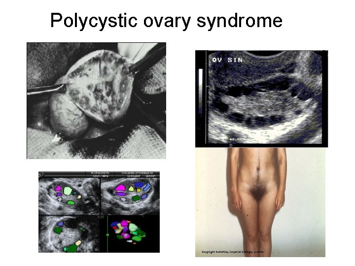 Polycystic ovary syndrome 