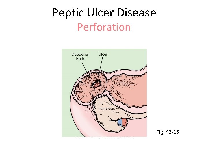 Peptic Ulcer Disease Perforation Fig. 42 -15 