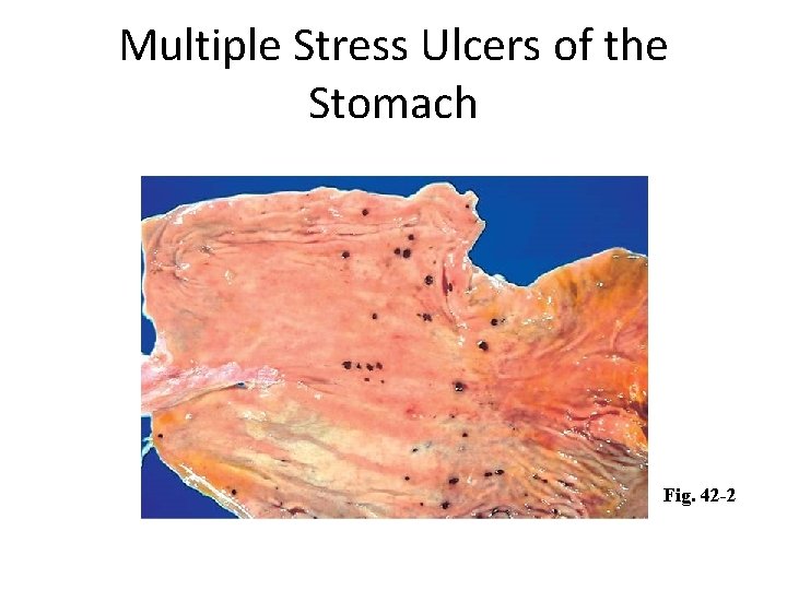 Multiple Stress Ulcers of the Stomach Fig. 42 -2 