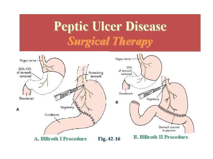 Peptic Ulcer Disease Surgical Therapy A. Billroth I Procedure Fig. 42 -16 B. Billroth