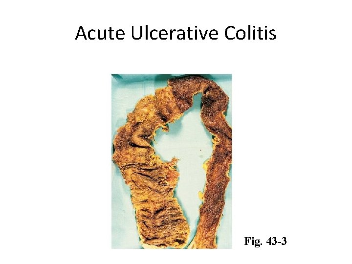 Acute Ulcerative Colitis Fig. 43 -3 