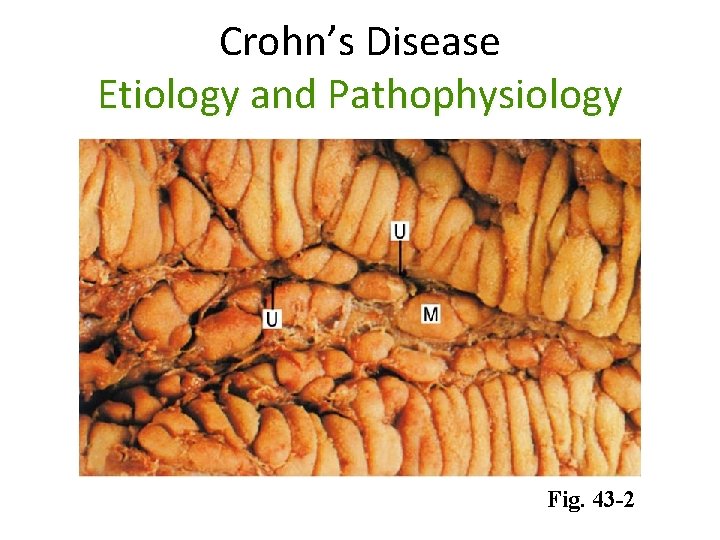Crohn’s Disease Etiology and Pathophysiology Fig. 43 -2 