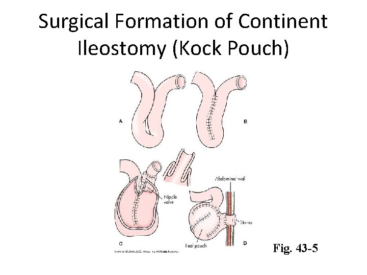 Surgical Formation of Continent Ileostomy (Kock Pouch) Fig. 43 -5 