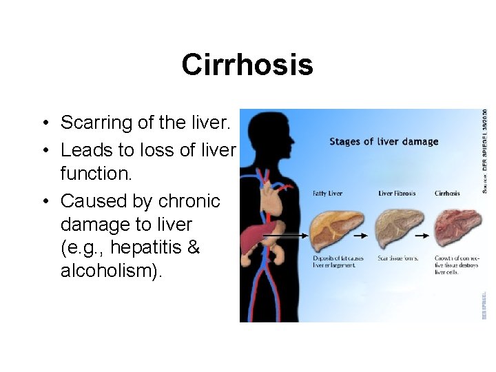 Cirrhosis • Scarring of the liver. • Leads to loss of liver function. •