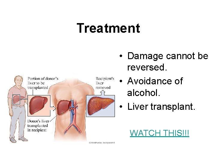 Treatment • Damage cannot be reversed. • Avoidance of alcohol. • Liver transplant. WATCH