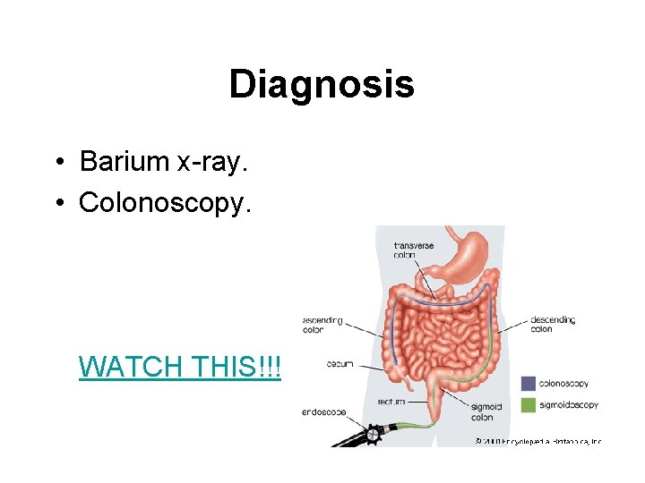 Diagnosis • Barium x-ray. • Colonoscopy. WATCH THIS!!! 