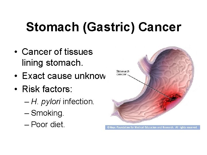 Stomach (Gastric) Cancer • Cancer of tissues lining stomach. • Exact cause unknown •