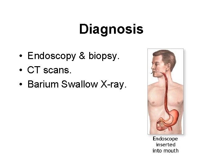 Diagnosis • Endoscopy & biopsy. • CT scans. • Barium Swallow X-ray. 