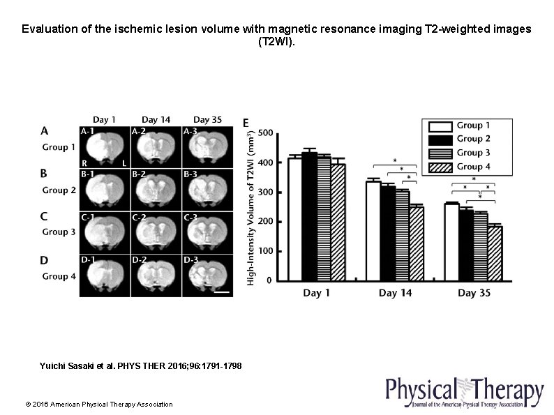 Evaluation of the ischemic lesion volume with magnetic resonance imaging T 2 -weighted images