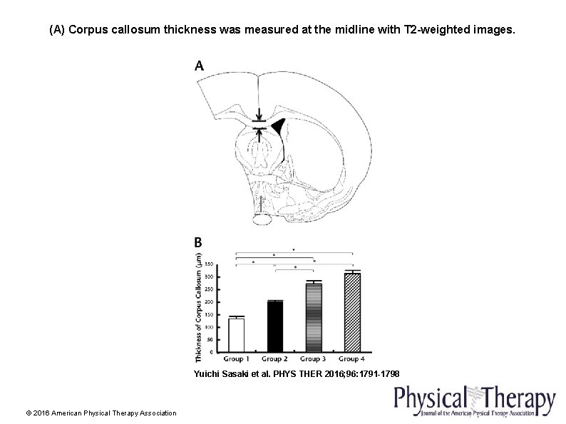 (A) Corpus callosum thickness was measured at the midline with T 2 -weighted images.