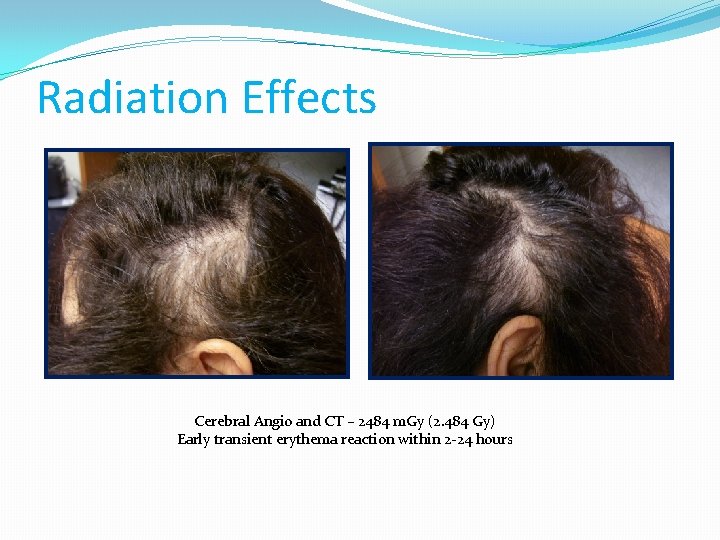 Radiation Effects Cerebral Angio and CT – 2484 m. Gy (2. 484 Gy) Early