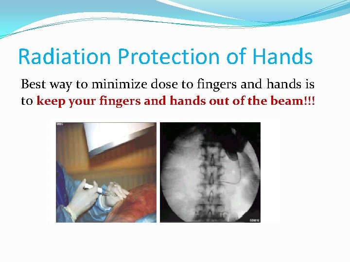 Radiation Protection of Hands Best way to minimize dose to fingers and hands is