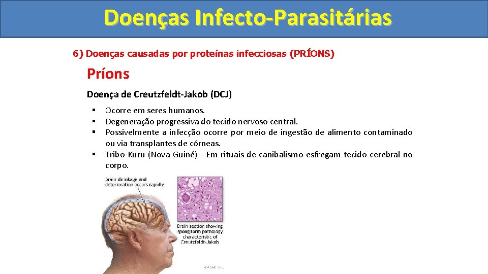 Doenças Infecto-Parasitárias 6) Doenças causadas por proteínas infecciosas (PRÍONS) Príons Doença de Creutzfeldt-Jakob (DCJ)
