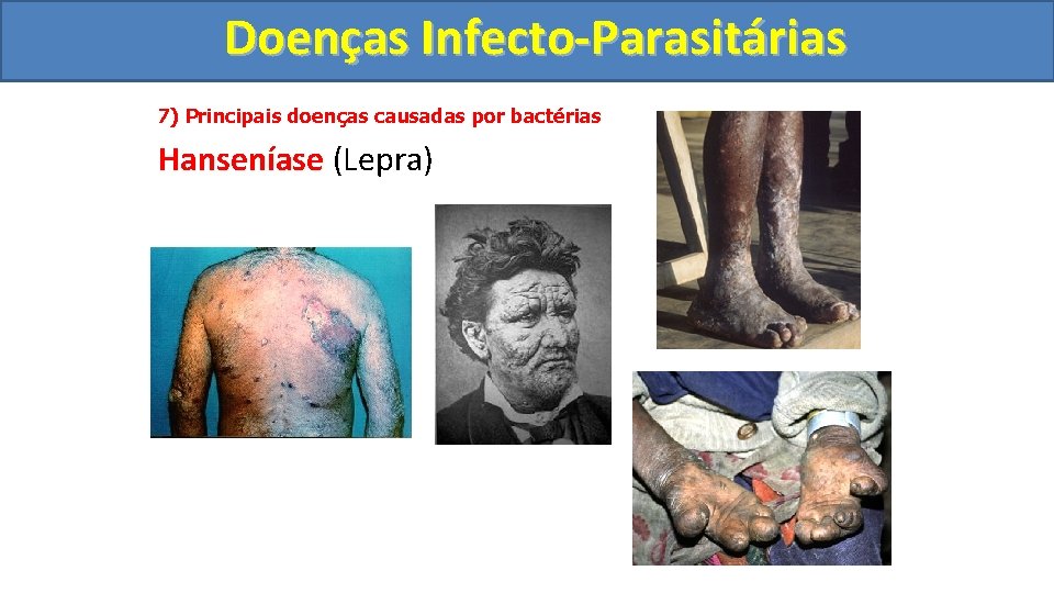Doenças Infecto-Parasitárias 7) Principais doenças causadas por bactérias Hanseníase (Lepra) 