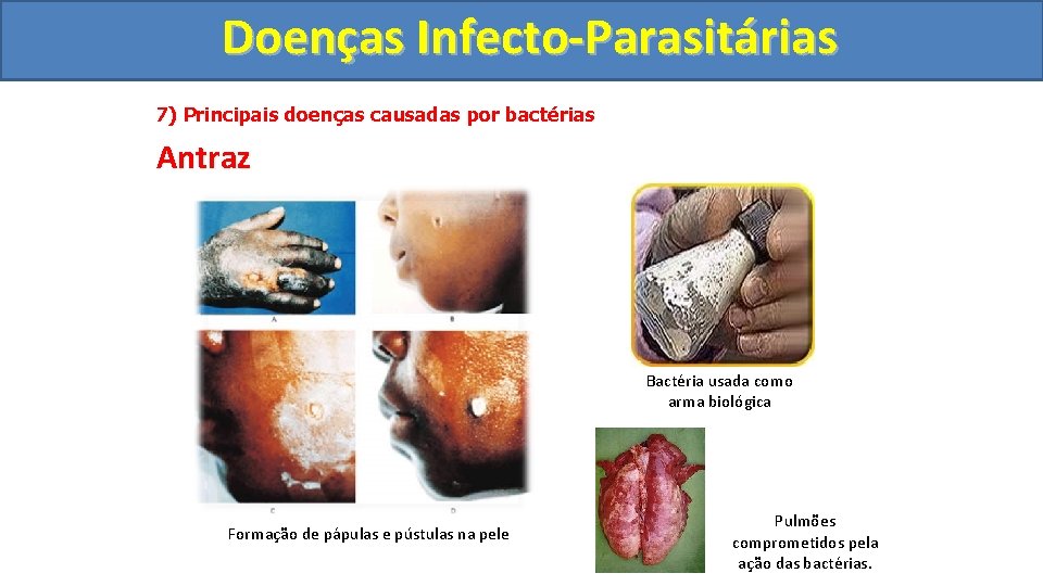 Doenças Infecto-Parasitárias 7) Principais doenças causadas por bactérias Antraz Bactéria usada como arma biológica