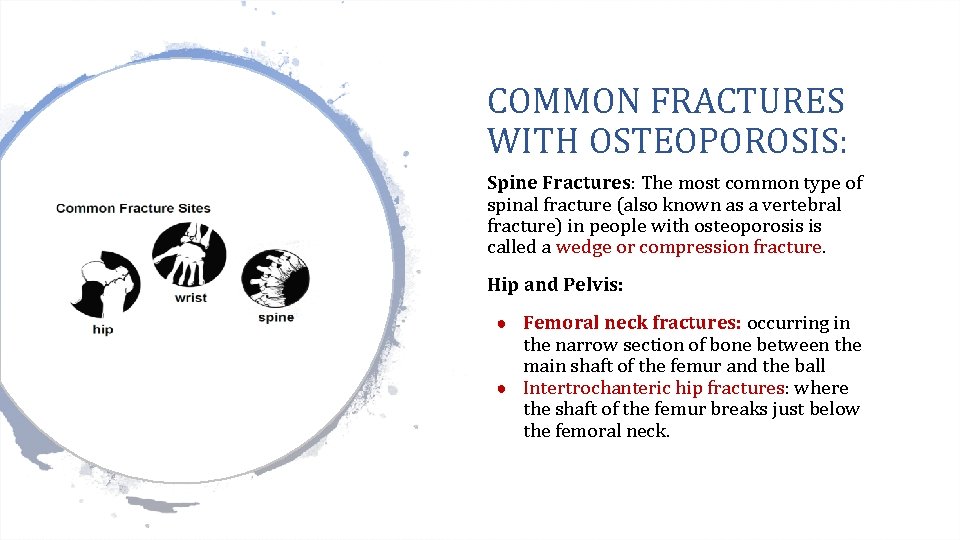 COMMON FRACTURES WITH OSTEOPOROSIS: Spine Fractures: The most common type of spinal fracture (also