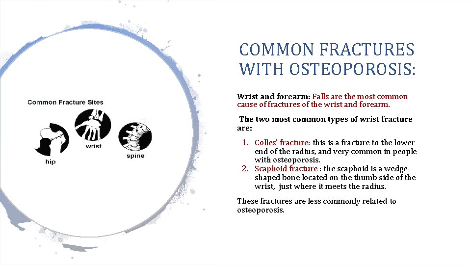 COMMON FRACTURES WITH OSTEOPOROSIS: Wrist and forearm: Falls are the most common cause of