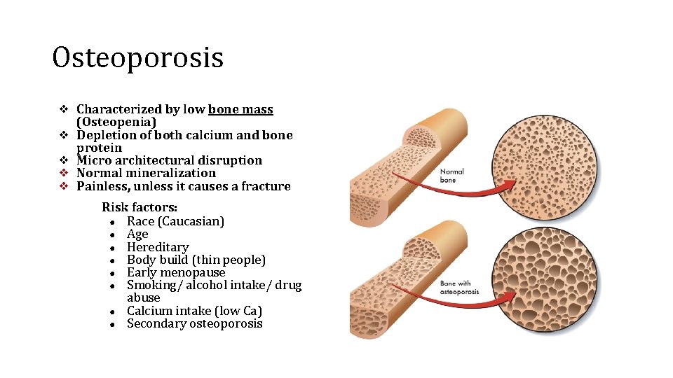 Osteoporosis ❖ Characterized by low bone mass ❖ ❖ (Osteopenia) Depletion of both calcium