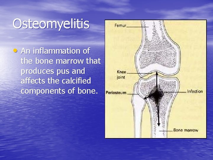 Osteomyelitis • An inflammation of the bone marrow that produces pus and affects the