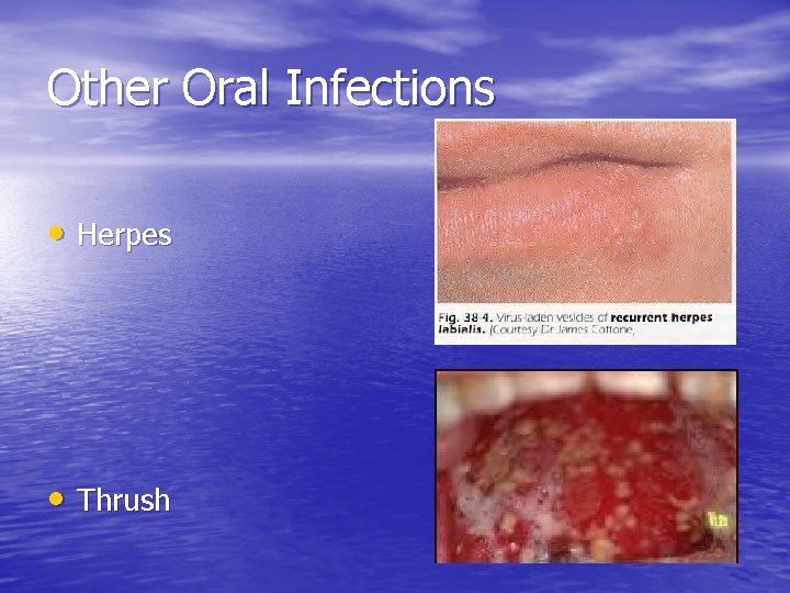 Other Oral Infections • Herpes • Thrush 