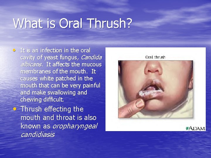 What is Oral Thrush? • It is an infection in the oral cavity of