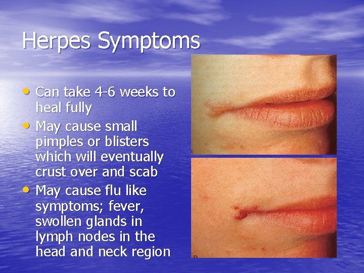 Herpes Symptoms • Can take 4 -6 weeks to • • heal fully May