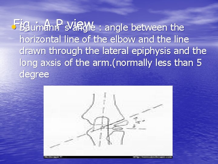 : A P view • Fig Baumann`s angle : angle between the horizontal line