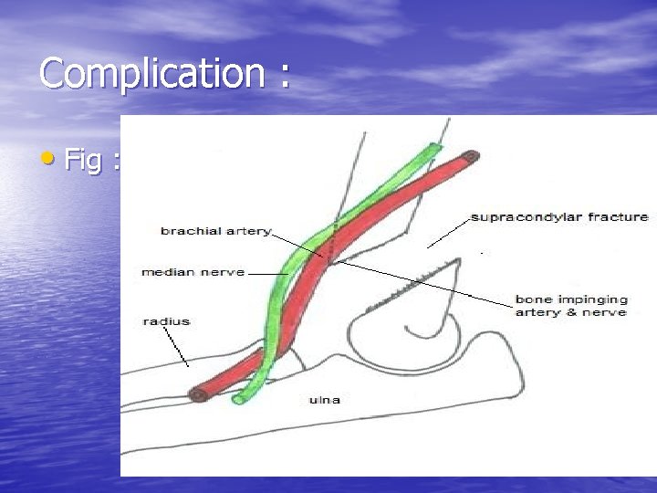 Complication : • Fig : 