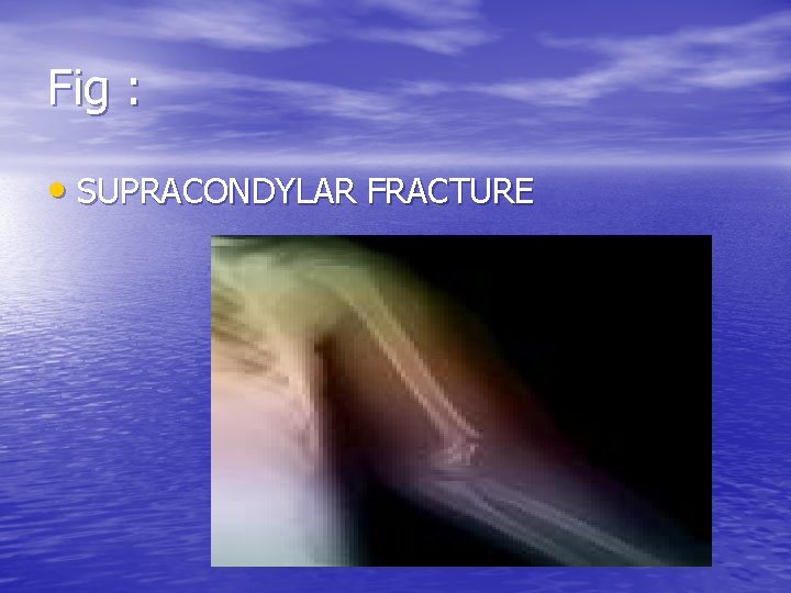 Fig : • SUPRACONDYLAR FRACTURE 