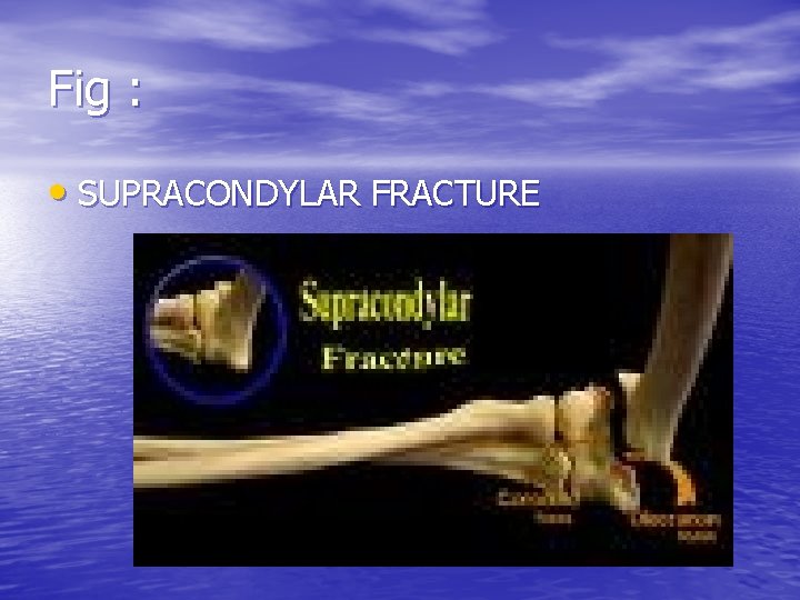 Fig : • SUPRACONDYLAR FRACTURE 