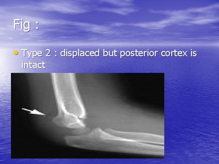 Fig : • Type 2 : displaced but posterior cortex is intact 