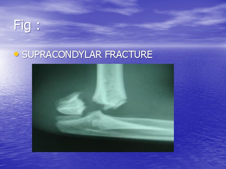 Fig : • SUPRACONDYLAR FRACTURE 
