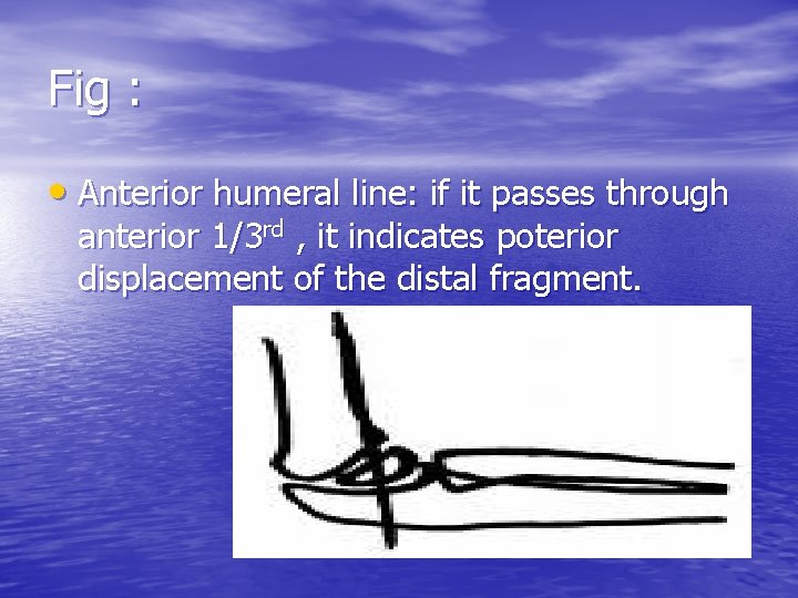 Fig : • Anterior humeral line: if it passes through anterior 1/3 rd ,