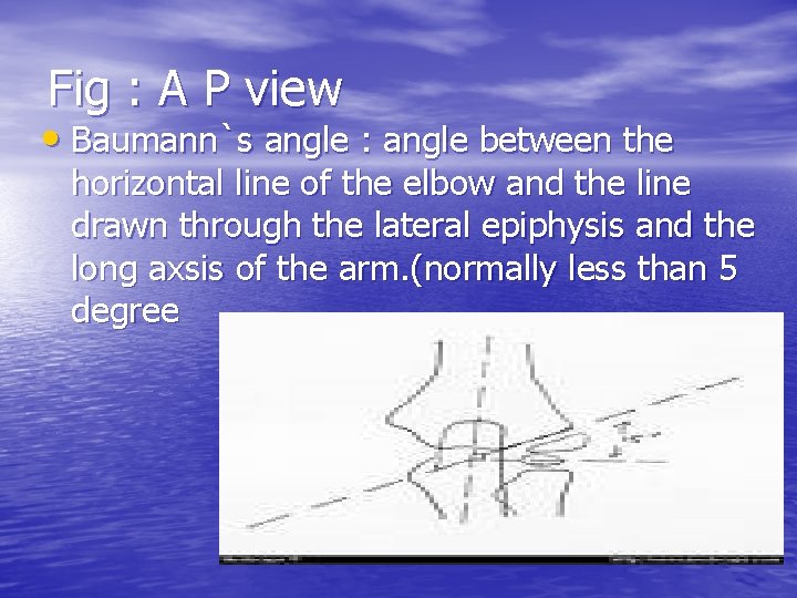 Fig : A P view • Baumann`s angle : angle between the horizontal line